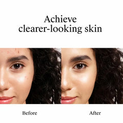 Neutrogena Rapid Clear Stubborn Acne Spot Treatment Gel with Maximum Strength for Acne Prone Skin - 1 oz: Paraben-Free, Aluminum-Free, Dye-Free